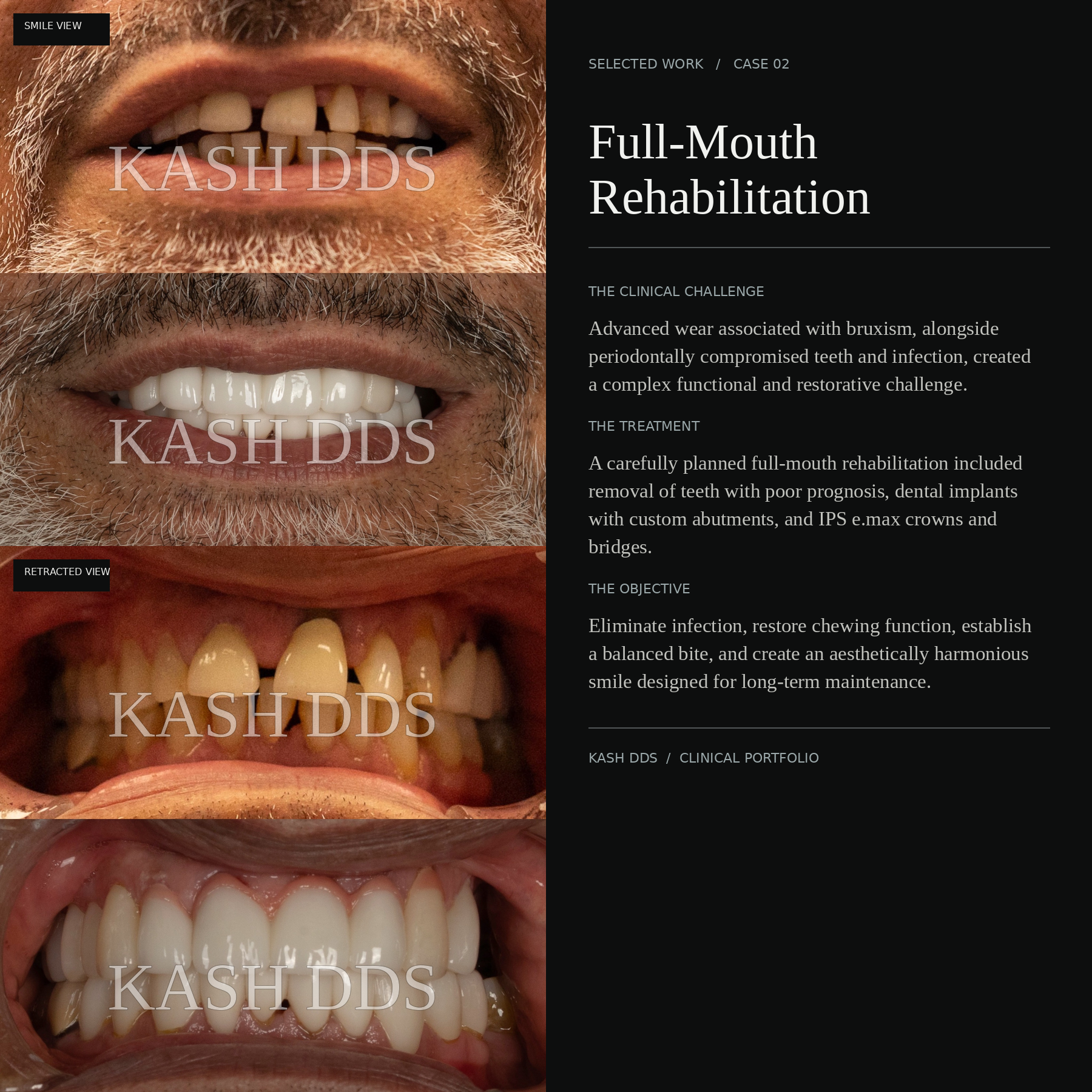 KASH DDS Case 02 with original before-and-after smile and retracted-view photography, watermarked, and clinical narrative alongside