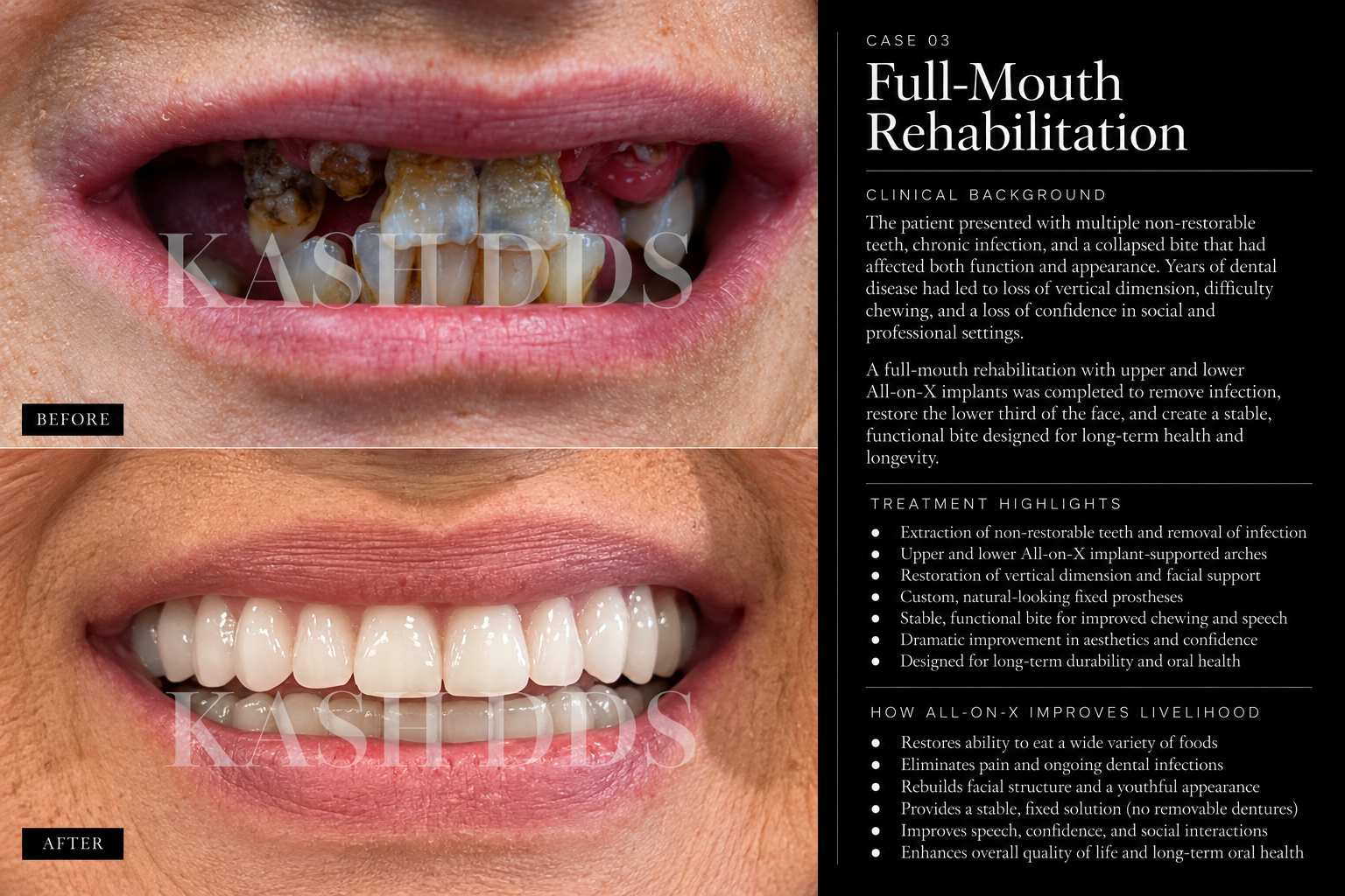 KASH DDS case 03 before and after rehabilitation with narrative